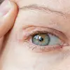 رنگپریدگی داخل پلکها